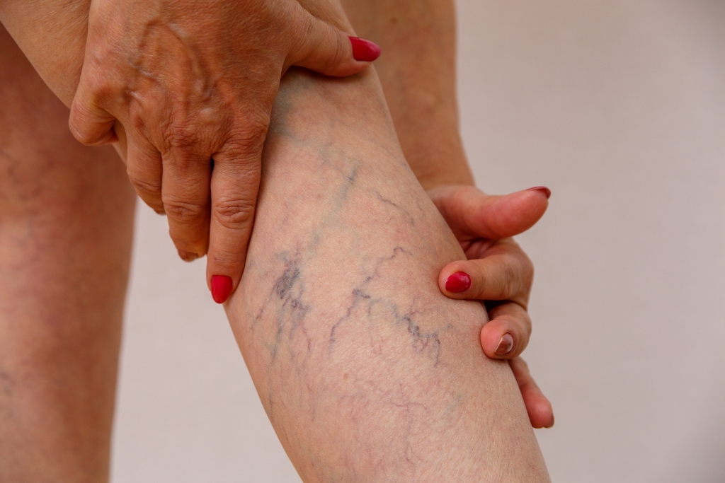 Mulher segurando a perna com veias varicosas visíveis