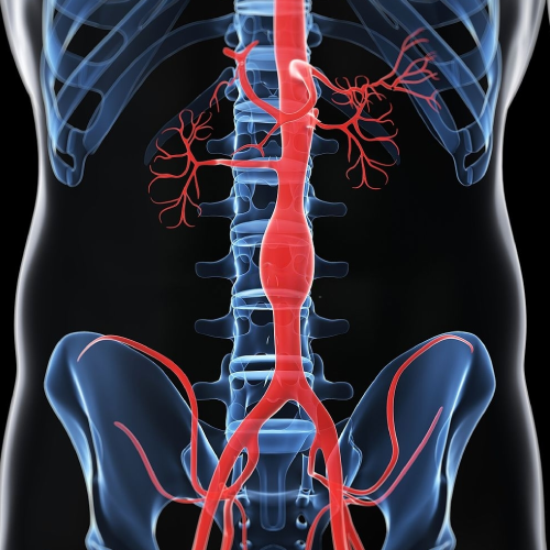 Ilustração anatômica da aorta abdominal com dilatação aneurismática