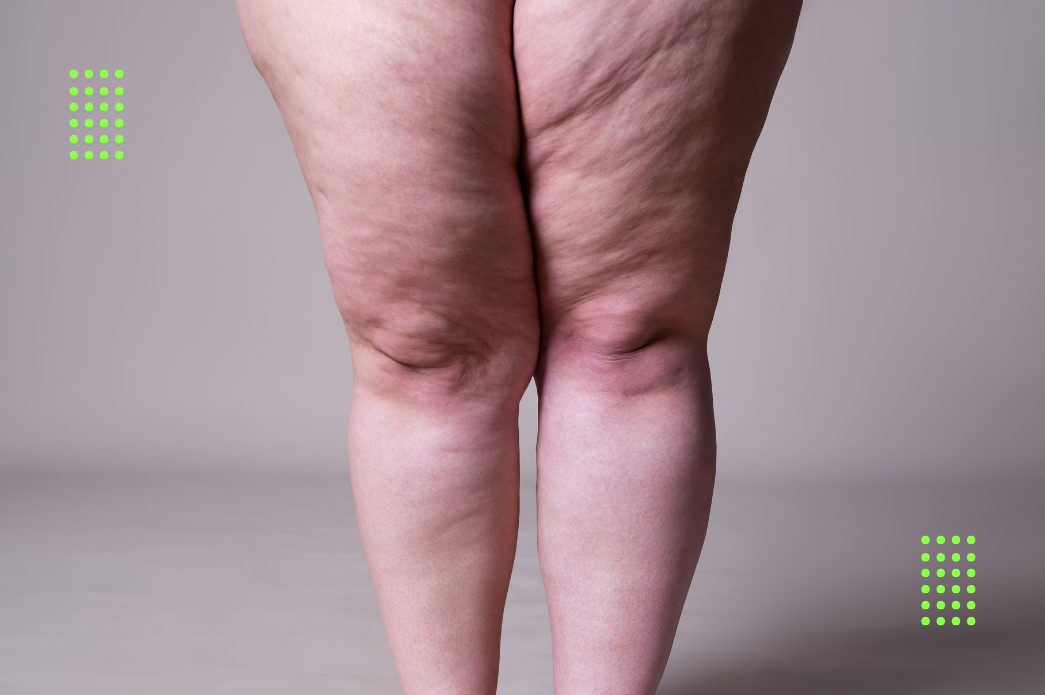 Pernas com acúmulo desproporcional de gordura característico do lipedema